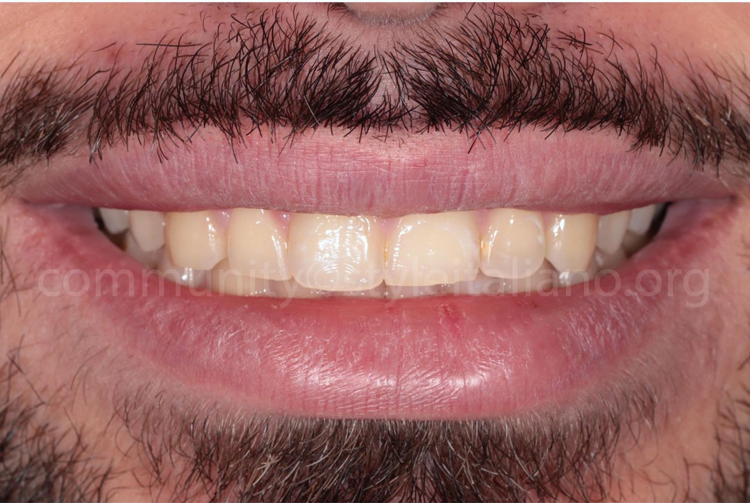 Styleitaliano_2024_56_24_HASBINI_01 styleitaliano style italiano Initial situation white dental beauty restoring and preserving dental esthetics occlusal function