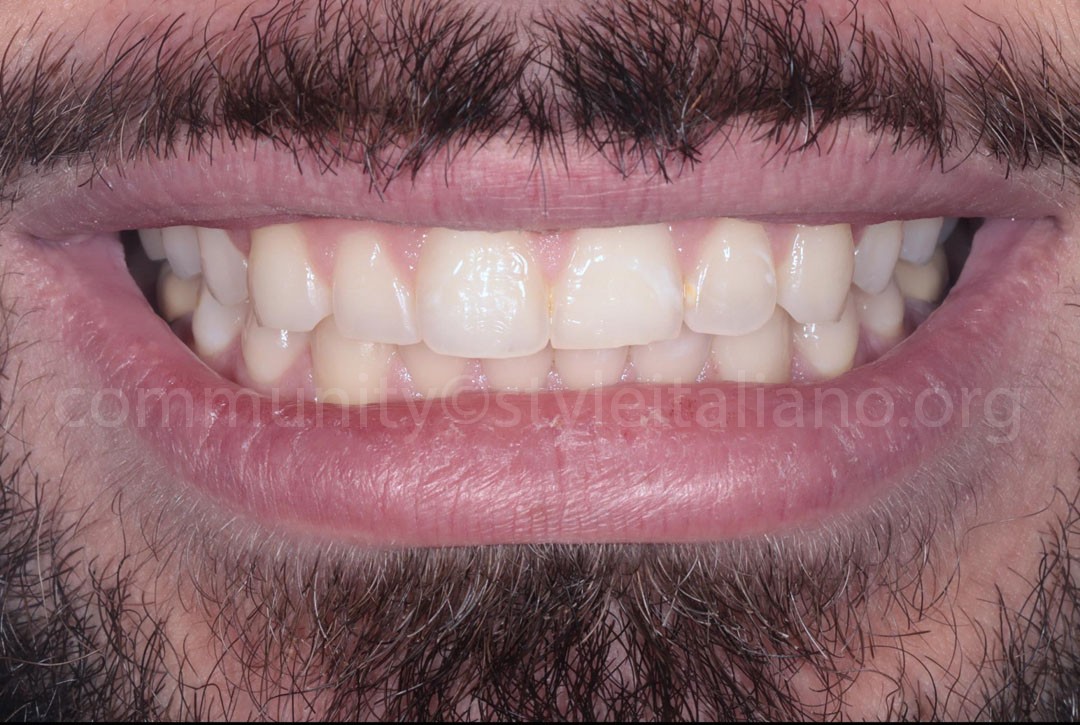 Styleitaliano_2024_56_24_HASBINI_04 styleitaliano style italiano after bleaching white dental beauty restoring and preserving dental esthetics occlusal function