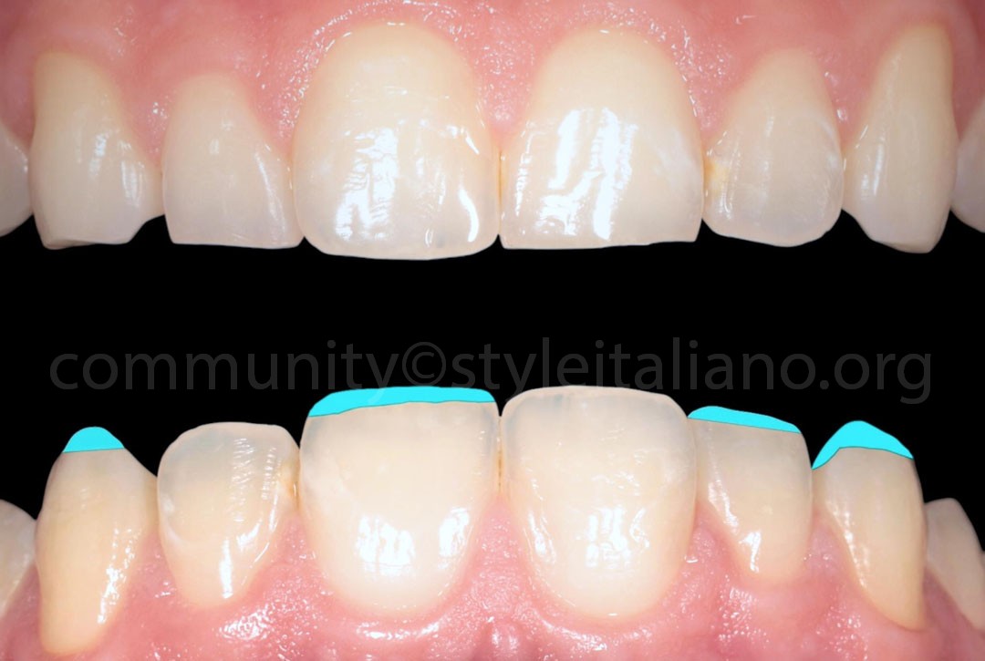 Styleitaliano_2024_56_24_HASBINI_07 styleitaliano style italiano Digital wax-up white dental beauty restoring and preserving dental esthetics occlusal function