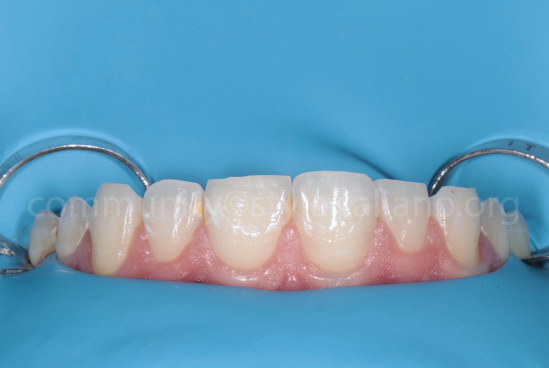 Styleitaliano_2024_56_24_HASBINI_10 styleitaliano style italiano Rubber dam isolation white dental beauty restoring and preserving dental esthetics occlusal function