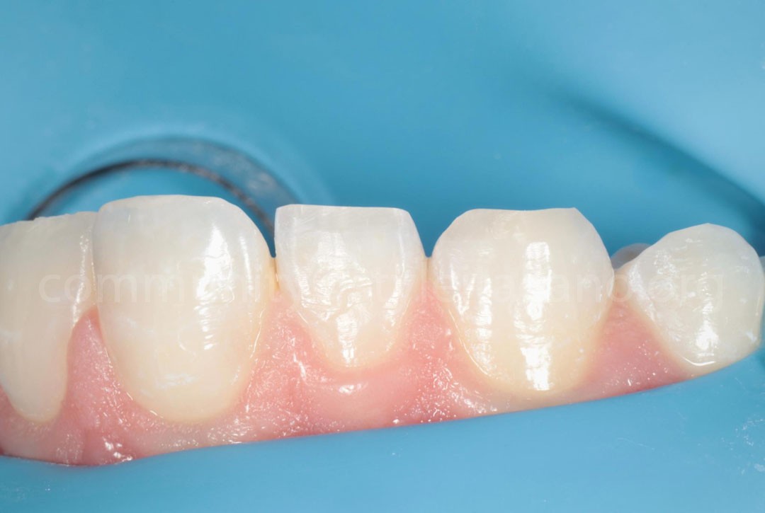 Styleitaliano_2024_56_24_HASBINI_11 styleitaliano style italiano Bevel creation white dental beauty restoring and preserving dental esthetics occlusal function