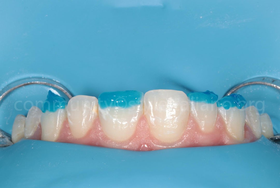 Styleitaliano_2024_56_24_HASBINI_12 styleitaliano style italiano Ortho phosphoric acid etching white dental beauty restoring and preserving dental esthetics occlusal function
