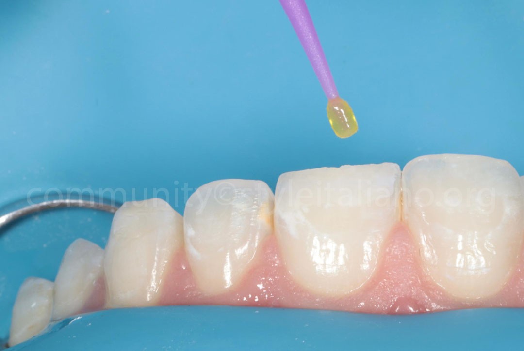 Styleitaliano_2024_56_24_HASBINI_13 styleitaliano style italiano Bonding application white dental beauty restoring and preserving dental esthetics occlusal function