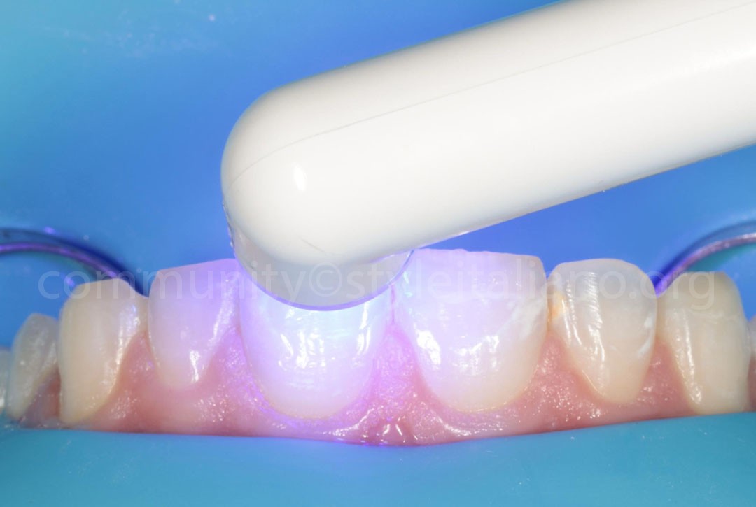 Styleitaliano_2024_56_24_HASBINI_14 styleitaliano style italiano Polymerization white dental beauty restoring and preserving dental esthetics occlusal function