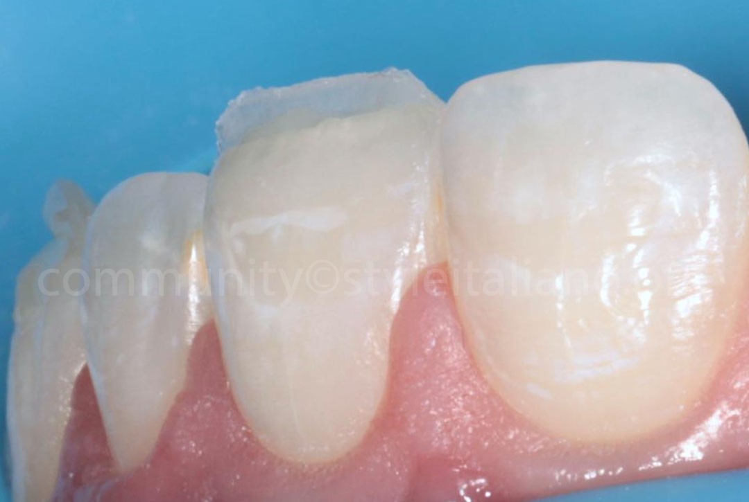 Styleitaliano_2024_56_24_HASBINI_17 styleitaliano style italiano Palatal shell creation white dental beauty restoring and preserving dental esthetics occlusal function