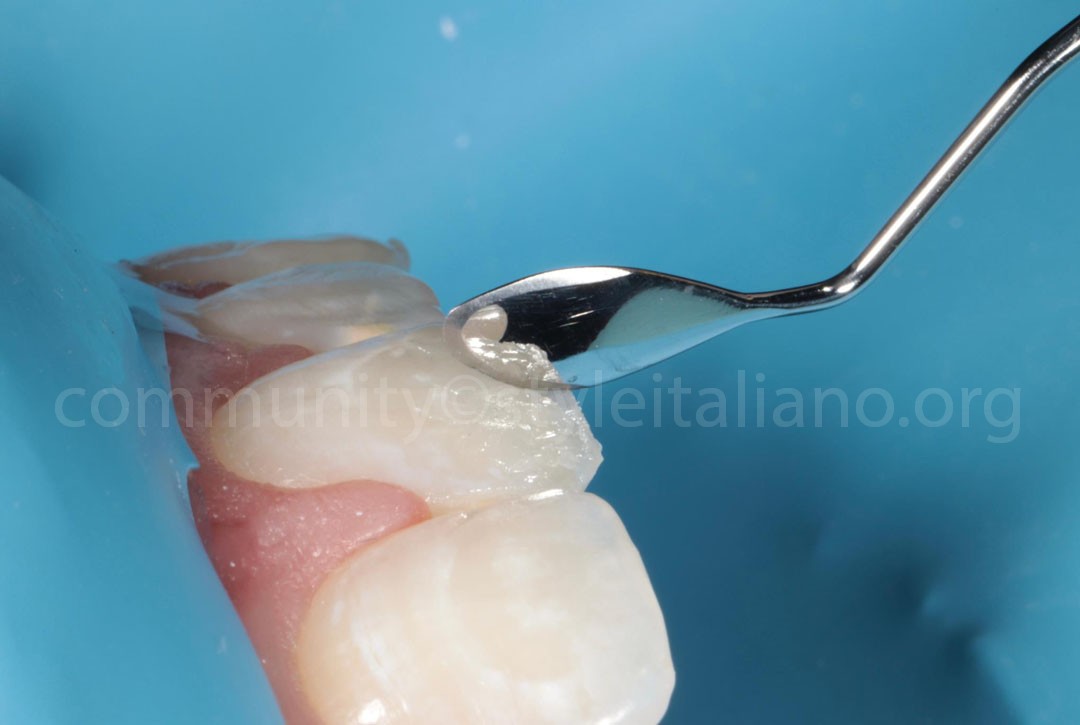 Styleitaliano_2024_56_24_HASBINI_18 styleitaliano style italiano Mamelons creation white dental beauty restoring and preserving dental esthetics occlusal function