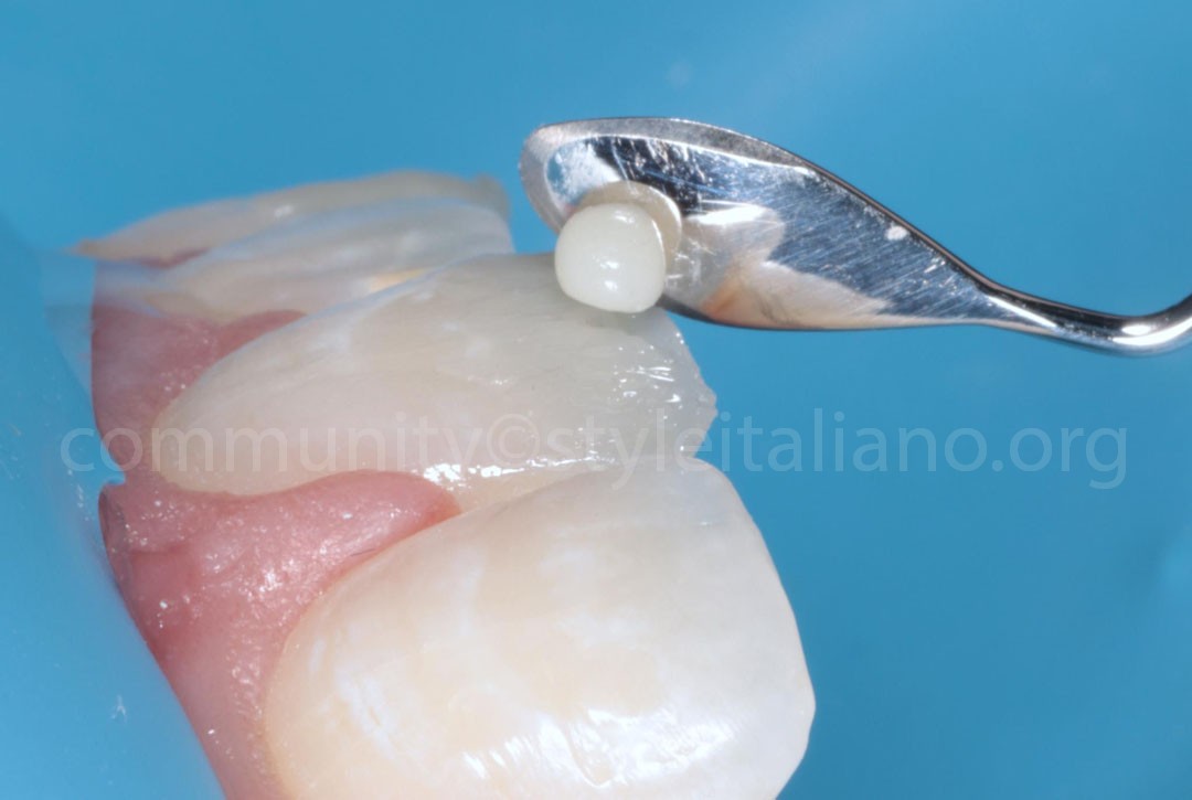 Styleitaliano_2024_56_24_HASBINI_19 styleitaliano style italiano Enamel application white dental beauty restoring and preserving dental esthetics occlusal function