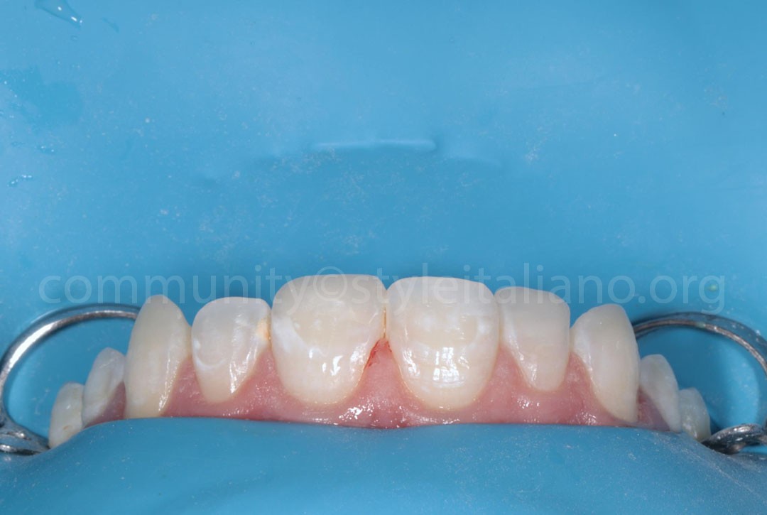 Styleitaliano_2024_56_24_HASBINI_20 styleitaliano style italiano final situation white dental beauty restoring and preserving dental esthetics occlusal function