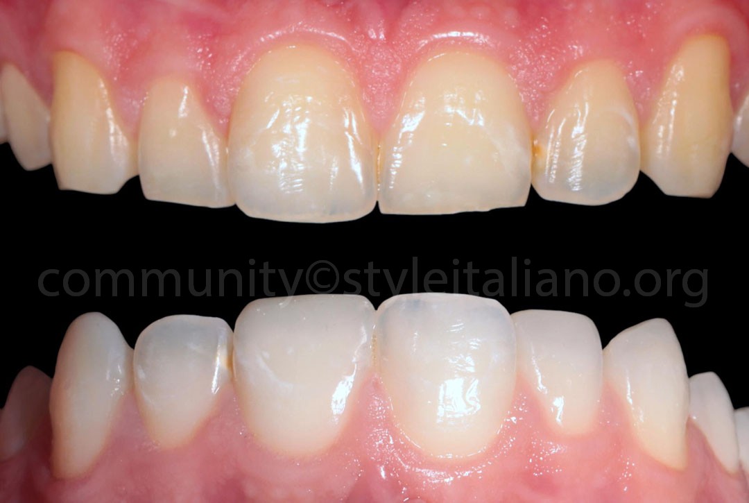 Styleitaliano_2024_56_24_HASBINI_22 styleitaliano style italiano before and after white dental beauty restoring and preserving dental esthetics occlusal function