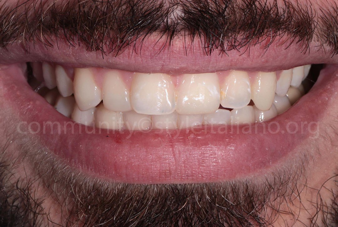 Styleitaliano_2024_56_24_HASBINI_25 styleitaliano style italiano Full smile of the patient white dental beauty restoring and preserving dental esthetics occlusal function