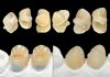Endocrown, Yes or Not? Definitive indirect restorations