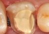 Bio-Bulk-Fill for build up in indirect restoration overlay preparation with biodentine substrate