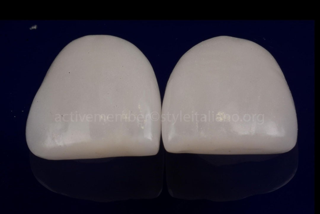 StyleItaliano_2026_43_26_DEVOTO_03 Zirconia veneers
