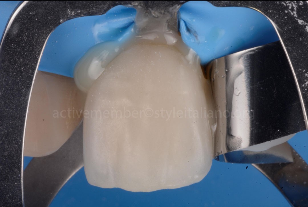 StyleItaliano_2026_43_26_DEVOTO_12 Cementation of the veneers