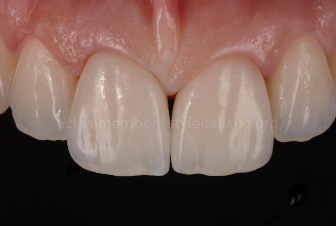 StyleItaliano_2026_43_26_DEVOTO_14 Final result Buccal view