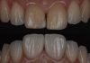From Darkness to Radiance: How Zirconia Veneers Restore Confidence dark teeth indirect veneers restoration