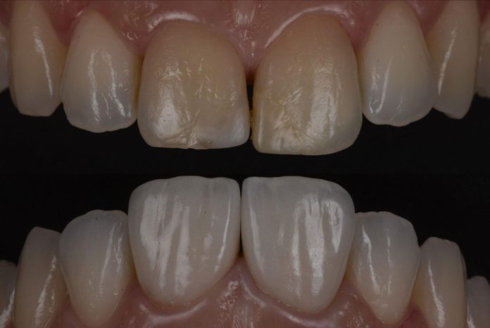 dark teeth indirect veneers restoration