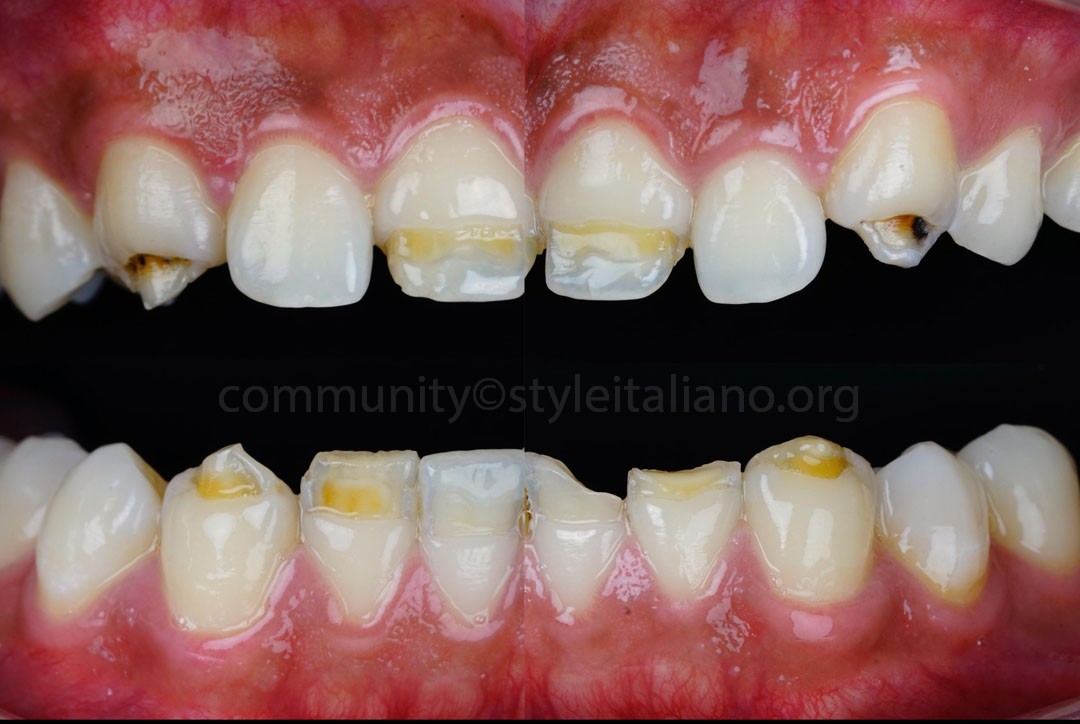 StyleItaliano_2026_44_26_Nghiem_01 intraoral situation of patient with enamel hypoplasia