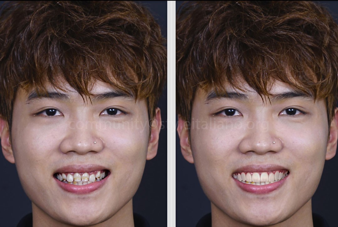 StyleItaliano_2026_44_26_Nghiem_02 extraoral digital smile design