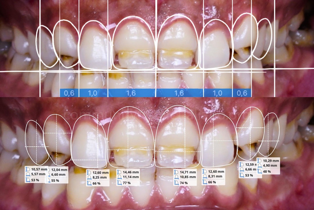 StyleItaliano_2026_44_26_Nghiem_03 intraoral digital smile design
