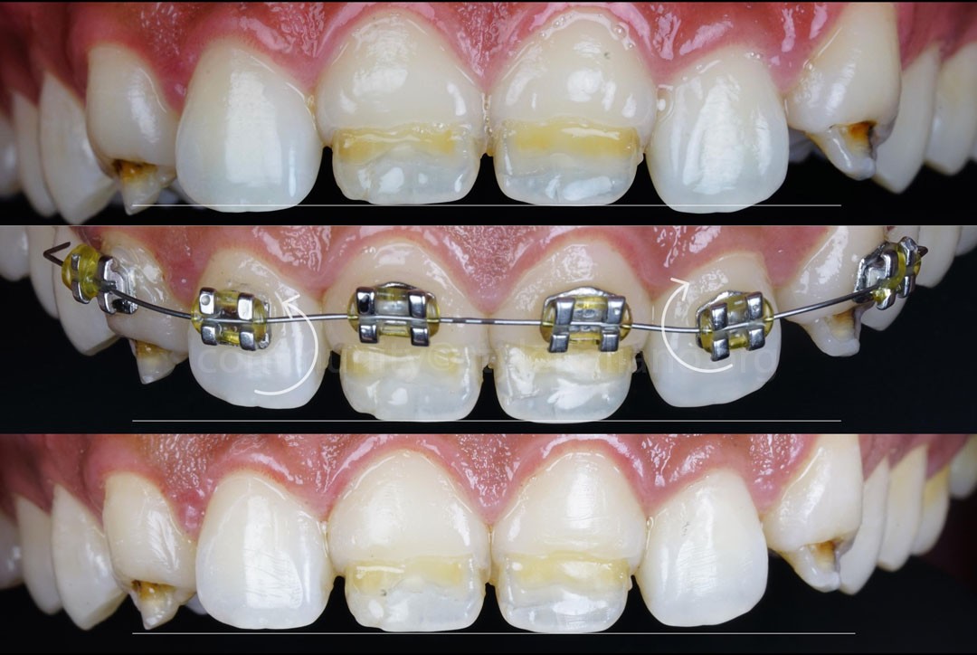 StyleItaliano_2026_44_26_Nghiem_05 orthodontic alignment before veneering