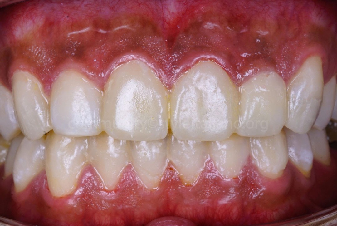 StyleItaliano_2026_44_26_Nghiem_06 mock-up for veneers