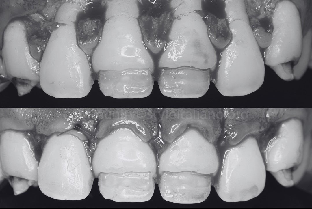 StyleItaliano_2026_44_26_Nghiem_07 apically position flap for gingival architecture redesign