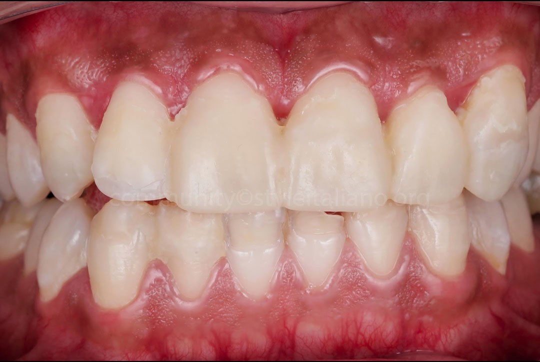 StyleItaliano_2026_44_26_Nghiem_08 provisional restorations after gingival surgery