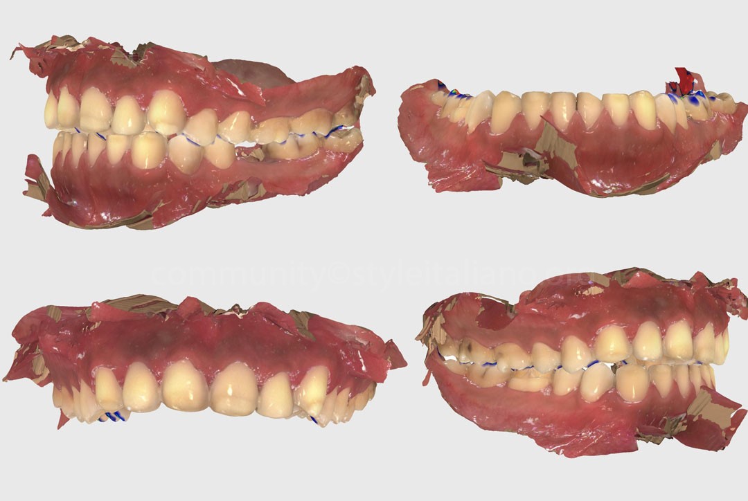 StyleItaliano_2026_44_26_Nghiem_14 intraoral scan for veneer fabrication