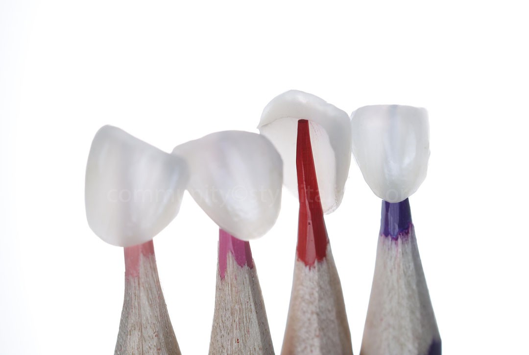 StyleItaliano_2026_44_26_Nghiem_15 lithium disilicate veneers