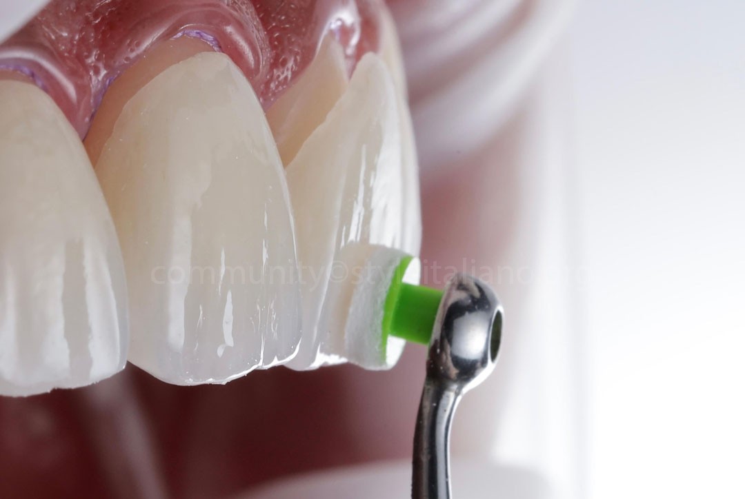 StyleItaliano_2026_44_26_Nghiem_16 lithium disilicate veneers