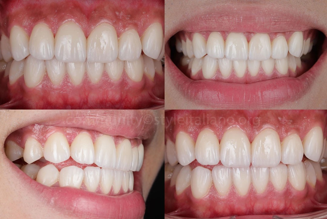 StyleItaliano_2026_44_26_Nghiem_17 after cementing lithium disilicate veneers