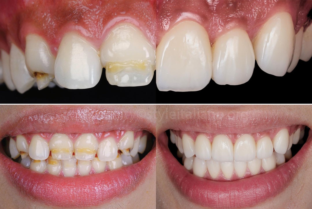 StyleItaliano_2026_44_26_Nghiem_18 before and after smile esthetic and functional rehabilitation