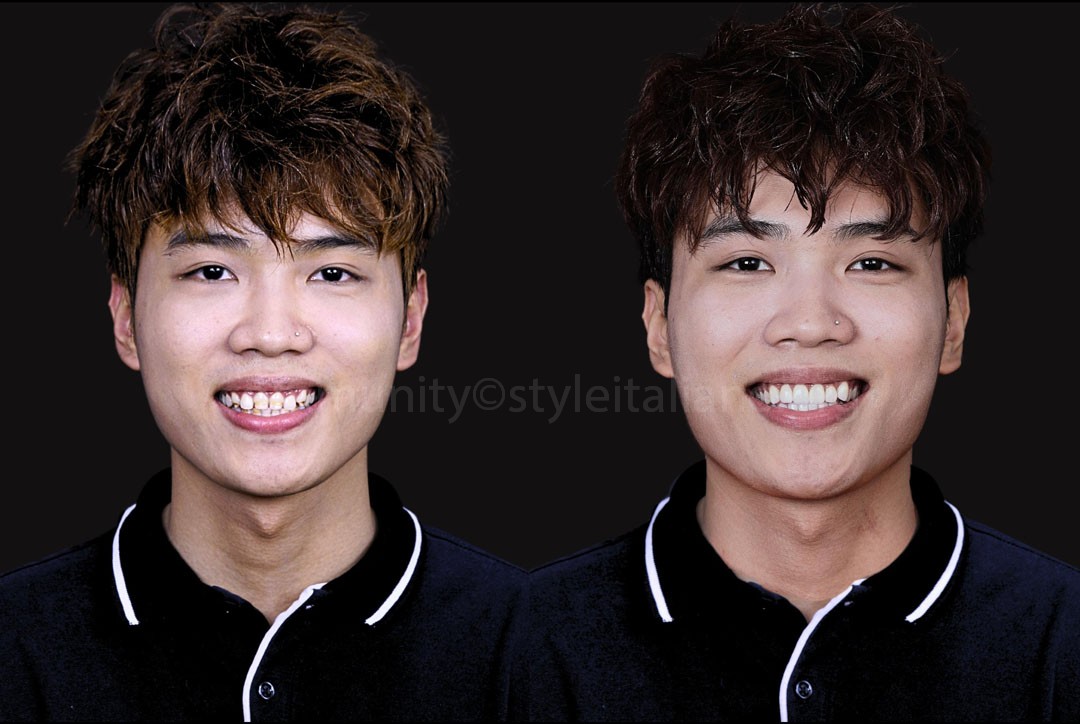 StyleItaliano_2026_44_26_Nghiem_20 before and after veneering