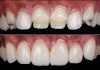 Managing Anterior Enamel Hypoplasia Through a Digital and Interdisciplinary Minimally Invasive Approach