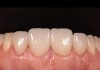 Simplifying Adhesive Cementation: A Predictable Workflow for Anterior Ceramic Veneers Simplifying Adhesive Cementation: A Predictable Workflow for Anterior Ceramic Veneers