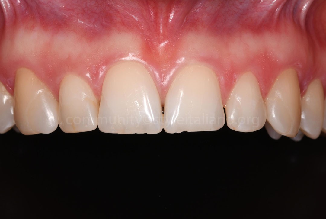 50_26_STRUNZ-01 situation after orthodontic treatment