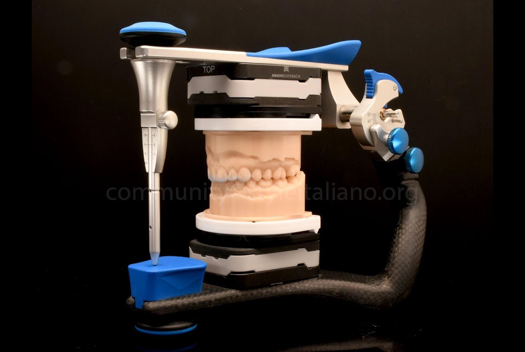 50_26_STRUNZ-02 study models before incisor reshaping