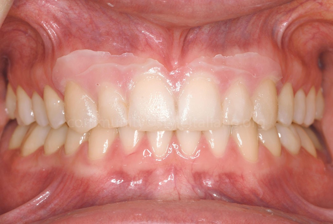 50_26_STRUNZ-04 mock-up for anterior restorations