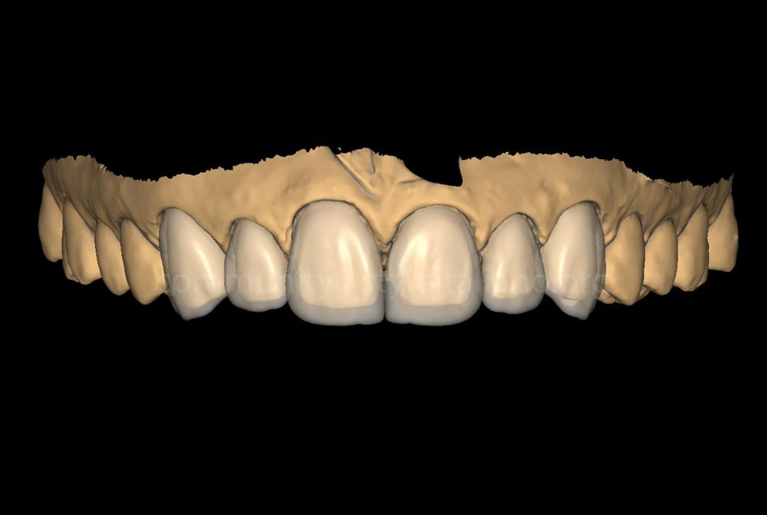 50_26_STRUNZ-07 digital project for ceramic veneers