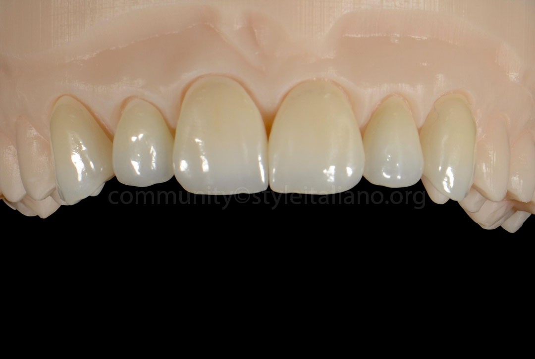 50_26_STRUNZ-08 zirconia veneers