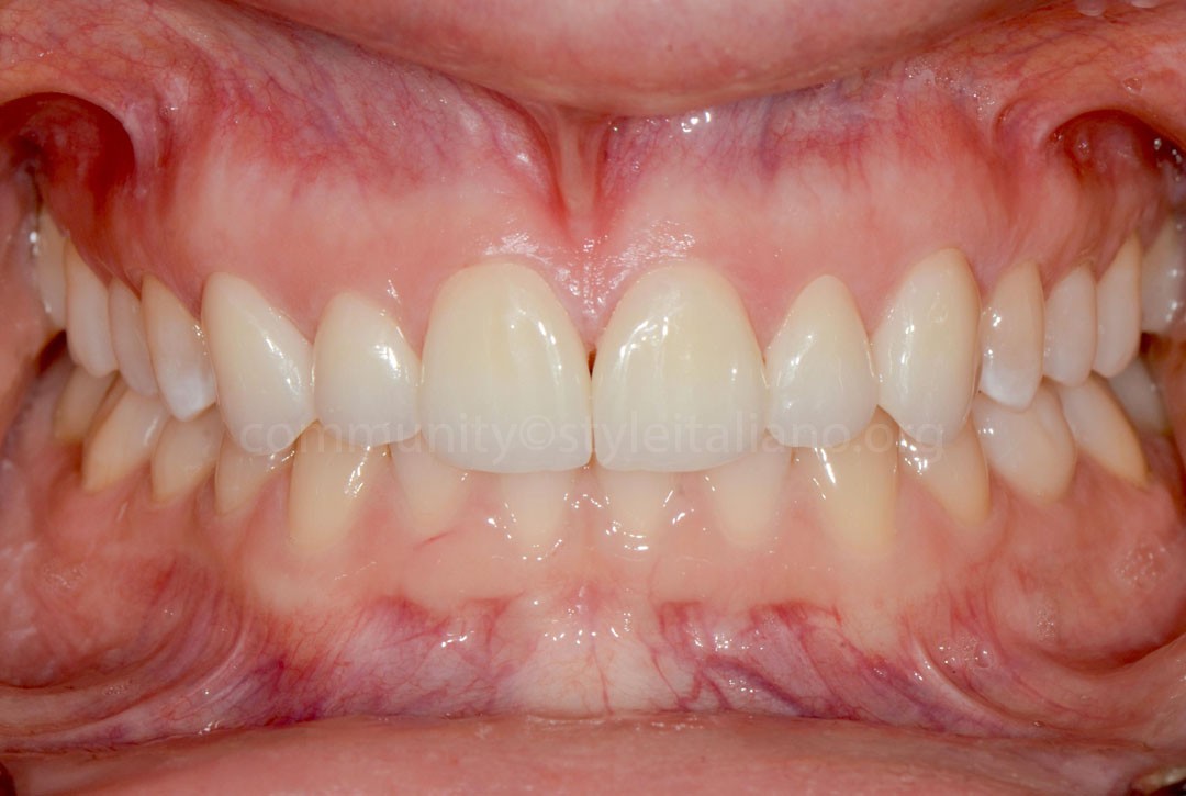 50_26_STRUNZ-09 after cementing zirconia veneers