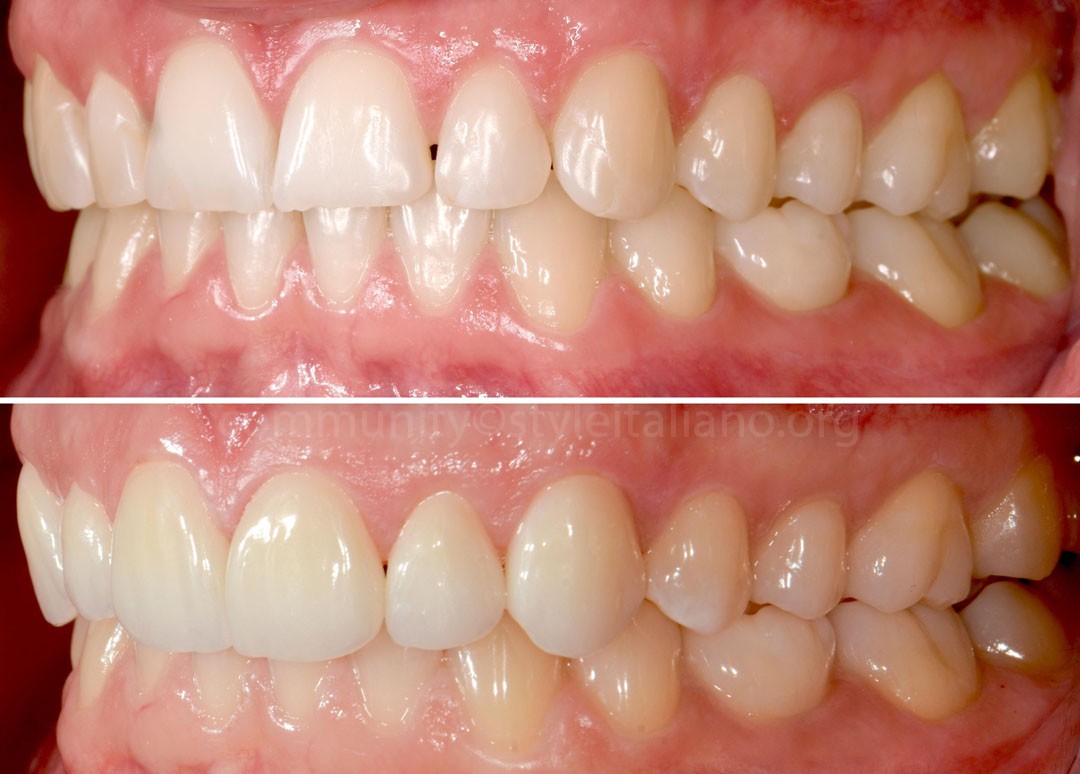 50_26_STRUNZ-10 before and after veneer restorations