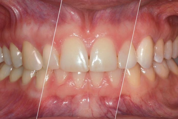 before during and after veneer treatment