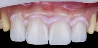 Simple and Predictable Protocols for Bonding Zirconia Restorations Bonding Zirconia Restorations with of Maxcem Elite™ Chroma cementation