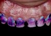 Polychromatic Direct Composite Rehabilitation Guided by a Digital Mock-up direct composite restoration digitally guided
