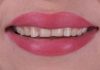 Clarity™ Aligner Therapy as a Pre-Prosthodontic Tool for Minimally Invasive Rehabilitation smile before teeth alignment and restoration