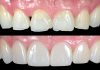 Reshaping the Smile: A Direct 6-Veneer Approach for Severe Wear, Black Triangles, and NCCLs Using the One-Shade Technique Before and after