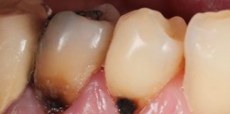Easy Matches in Class V Restorations Class V Restorations cervical area restoration