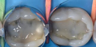 Restoring Structurally Compromised Teeth with a Direct Technique stages of direct cusp protection with composite